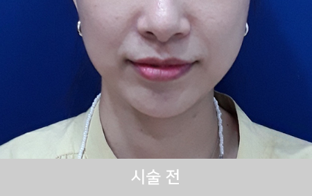before_Img